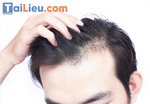 Nguyên nhân tóc rụng nhiều ở nam giới