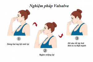 Thực hiện nghiệm pháp Valsalva sẽ giúp giảm chứng ù tai